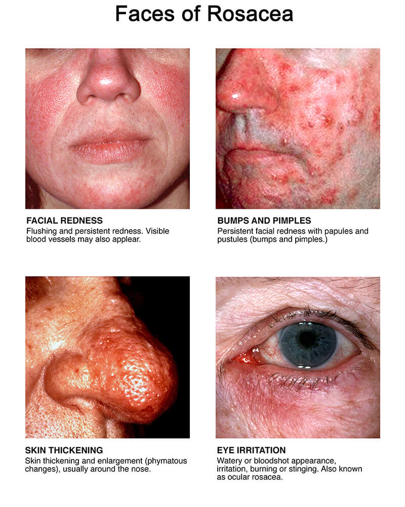 Rosacea skin deals